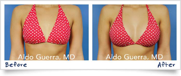 Breast Augmentation Before After Photo - Case 