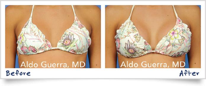 Actual before and after saline breast implant patient photo.