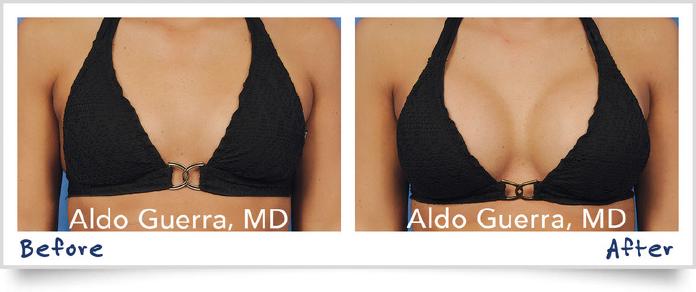 Actual before and after breast implants patient photo.