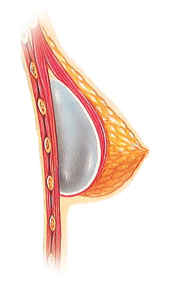 Breast Augmentation under the muscle placement diagram