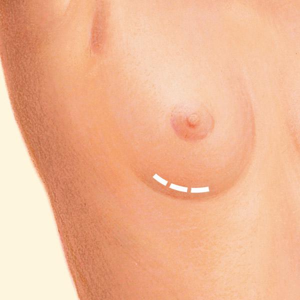 Breast crease incision diagram.