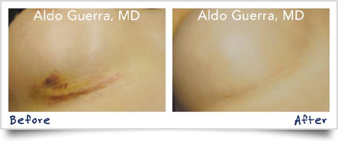 Embrace Active Scar Defense before and after 1 year, actual patient photo