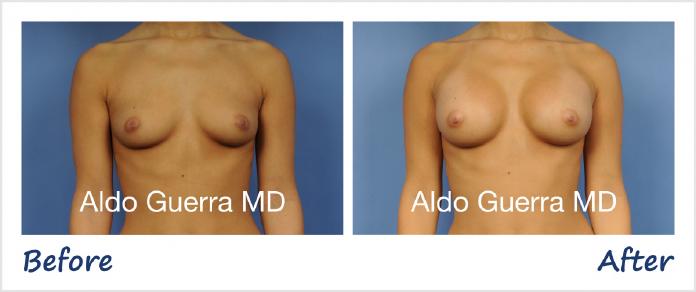 Breast Augmentation Before After Photo - Case 1001144 photo 1