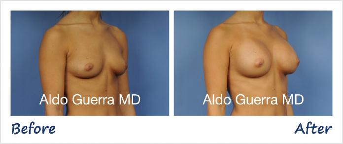 Breast Augmentation Before After Photo - Case 1001144 photo 4