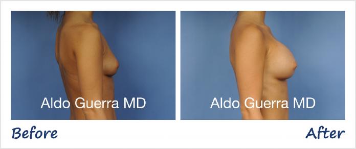 Breast Augmentation Before After Photo - Case 1001144 photo 5