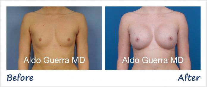Breast Augmentation Before After Photo - Case 1001188 photo 1