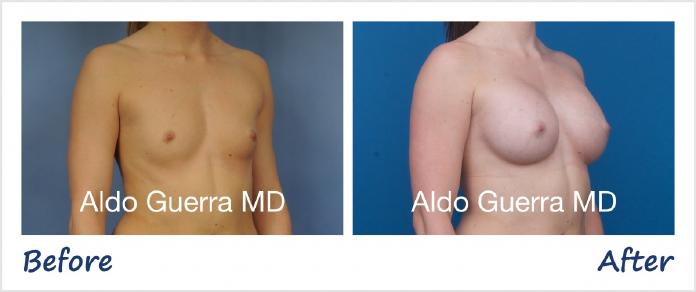 Breast Augmentation Before After Photo - Case 1001188 photo 4