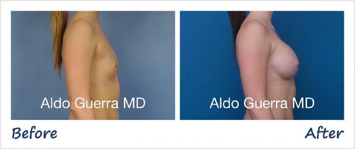 Breast Augmentation Before After Photo - Case 1001188 photo 5