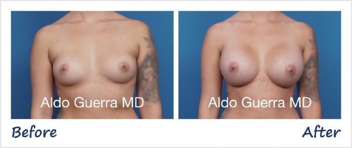 Breast Augmentation Before After Photo - Case 1006001 photo 1