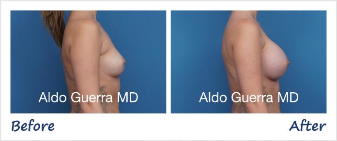 Breast Augmentation Before After Photo - Case 1006001 photo 5