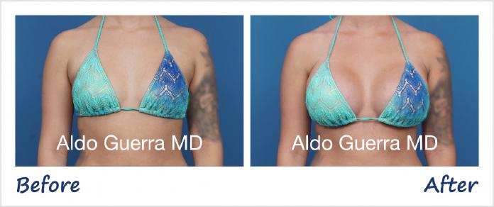 Breast Augmentation Before After Photo - Case 1006001 photo 6