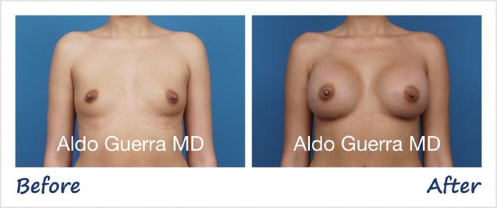 Breast Augmentation Before After Photo - Case 1006003 photo 1