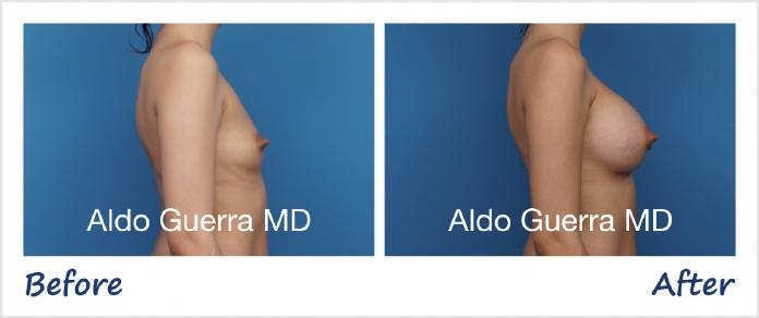 Breast Augmentation Before After Photo - Case 1006003 photo 5