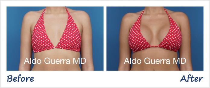 Breast Augmentation Before After Photo - Case 1006003 photo 4