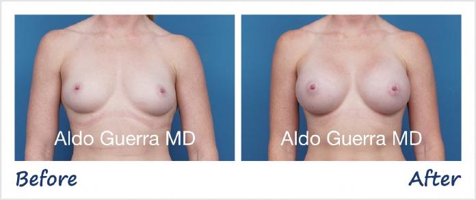 Breast Augmentation Before After Photo - Case 1006005 photo 1
