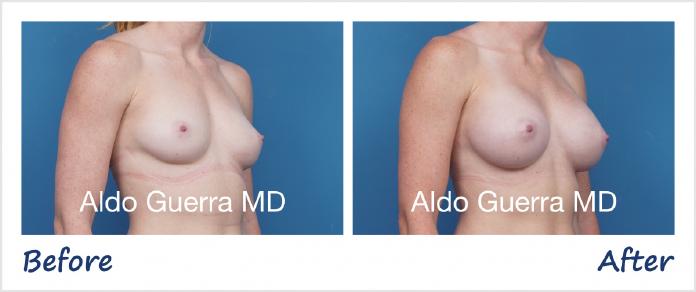 Breast Augmentation Before After Photo - Case 1006005 photo 4