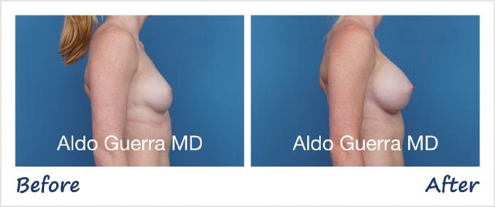 Breast Augmentation Before After Photo - Case 1006005 photo 5