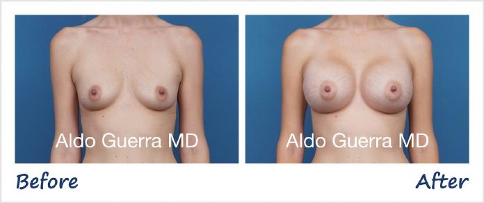 Breast Augmentation Before After Photo - Case 1006006 photo 1