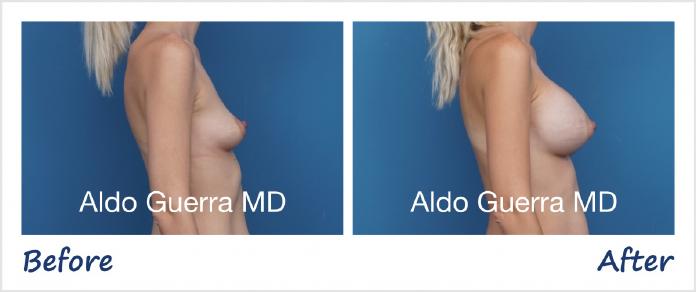 Breast Augmentation Before After Photo - Case 1006006 photo 5