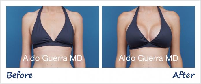 Breast Augmentation Before After Photo - Case 1006006 photo 4