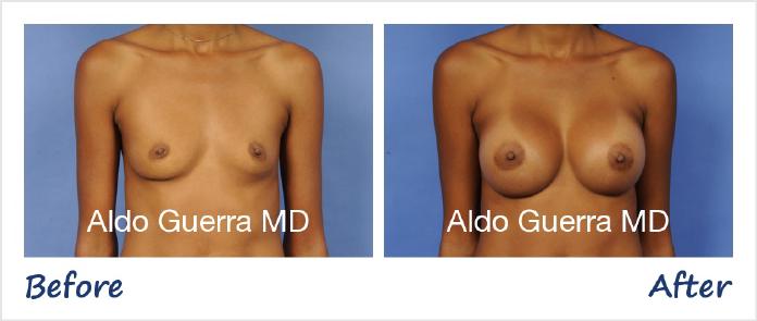 Breast Augmentation Before After Photo - Case 13126 photo 1