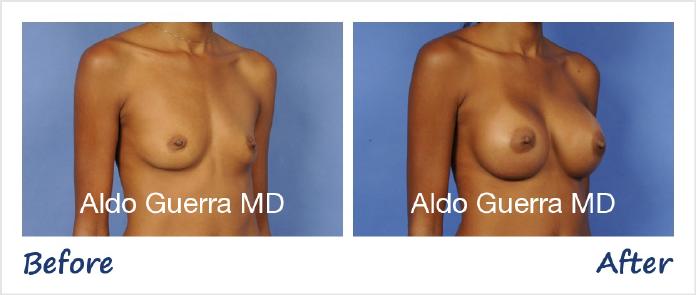 Breast Augmentation Before After Photo - Case 13126 photo 4