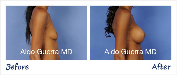Breast Augmentation Before After Photo - Case 13126 photo 5