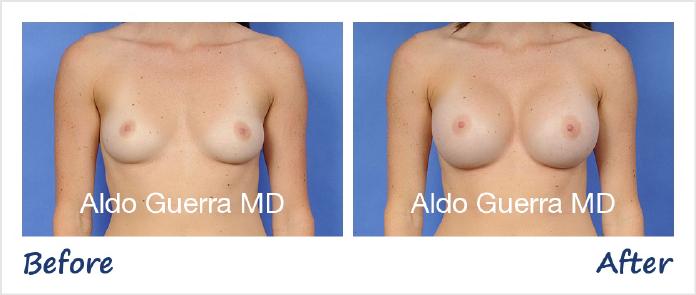 Breast Augmentation Before After Photo - Case 30474 photo 1