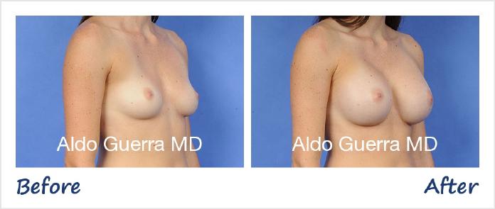 Breast Augmentation Before After Photo - Case 30474 photo 4