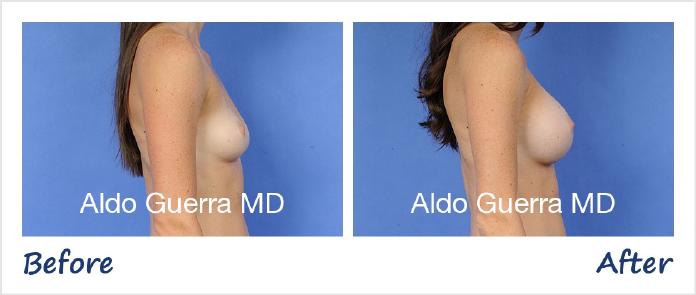 Breast Augmentation Before After Photo - Case 30474 photo 5