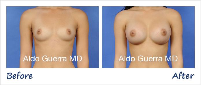 Breast Augmentation Before After Photo - Case 30993 photo 1
