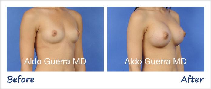 Breast Augmentation Before After Photo - Case 30993 photo 4