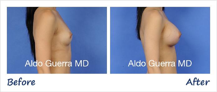 Breast Augmentation Before After Photo - Case 30993 photo 5