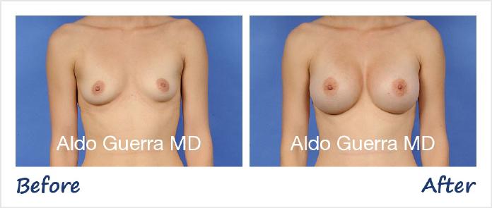 Breast Augmentation Before After Photo - Case 66659 photo 1