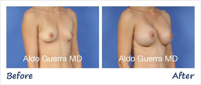 Breast Augmentation Before After Photo - Case 66659 photo 4
