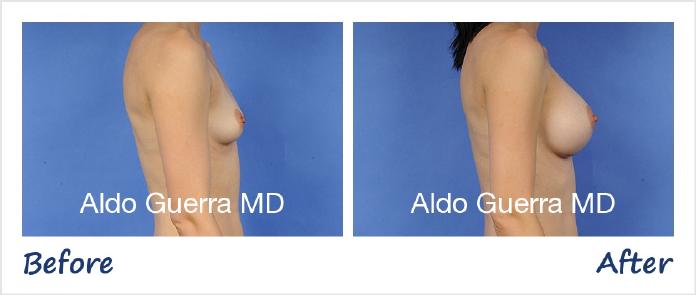 Breast Augmentation Before After Photo - Case 66659 photo 5