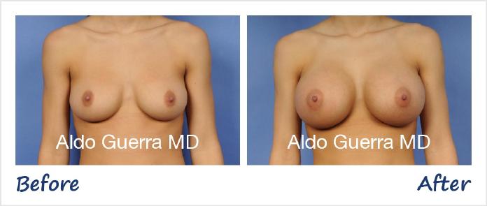 Breast Augmentation Before After Photo - Case 68795 photo 1
