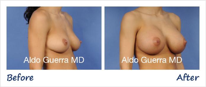 Breast Augmentation Before After Photo - Case 68795 photo 4