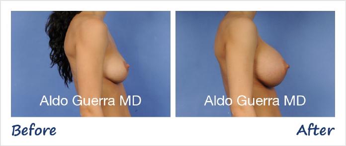Breast Augmentation Before After Photo - Case 68795 photo 5