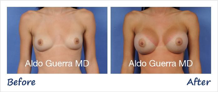 Breast Augmentation Before After Photo - Case 76589 photo 1