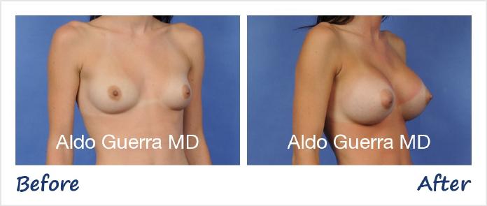 Breast Augmentation Before After Photo - Case 76589 photo 4