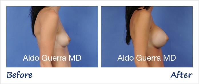 Breast Augmentation Before After Photo - Case 76589 photo 5