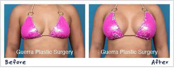Actual patient, before and after breast augmentation